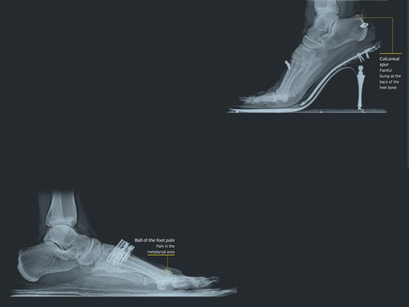 high heels throw you forward putting pressure on the front of the foot an x ray of a right foot in kolhapuri chappals which lead to flat feet or loss of the arch images radiologist nasiruddin at south city hospital