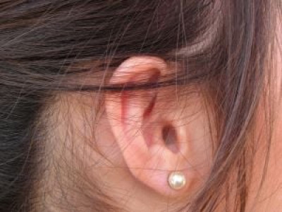 hearing abilities after cochlear implant surgery two children discover sounds