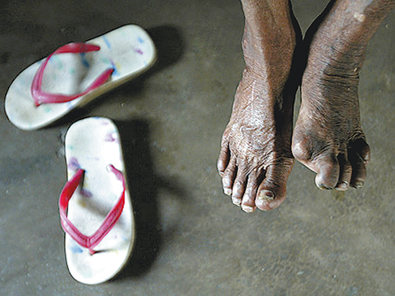 only 16 countries account for 95 of new cases that are detected worldwide sixteen million leprosy patients have been completely cured in the past three decades photo reuters