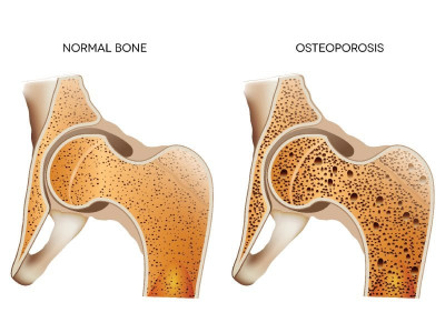 osteoporosis breaking back