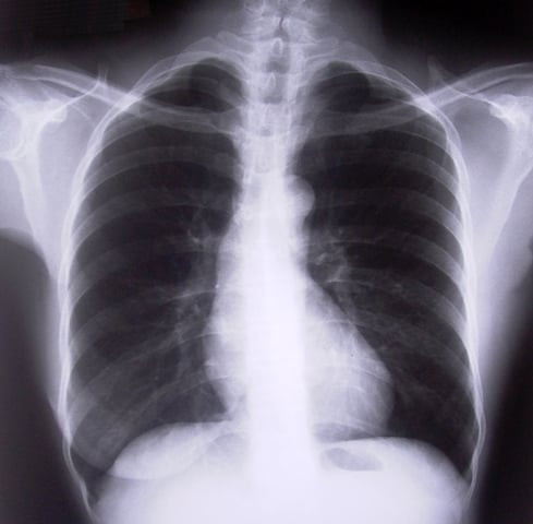 0 2 out 15 million in the area suffer from some kind of lung disease photo file 0 2 out 15 million in the area suffer from some kind of lung disease photo file