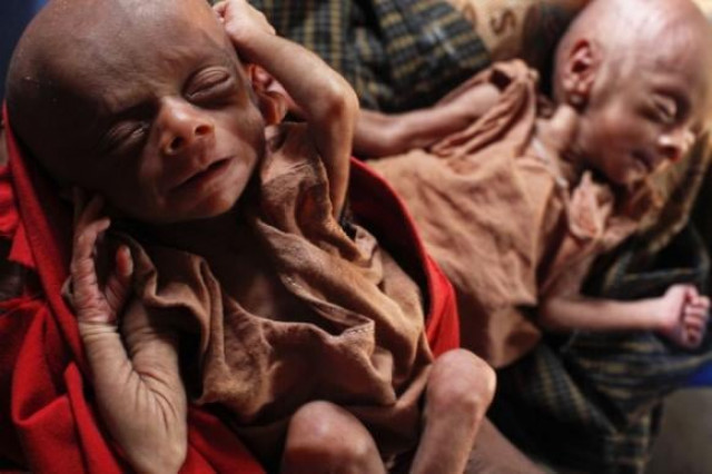 severely malnourished 25 day old twins are held by her mother norbagoun a displaced rohingya woman in their house at the dar paing camp for internally displaced people in sittwe rakhine state april 24 2014 photo reuters severely malnourished 25 day old twins are held by her mother norbagoun a displaced rohingya woman in their house at the dar paing camp for internally displaced people in sittwe rakhine state april 24 2014 photo reuters