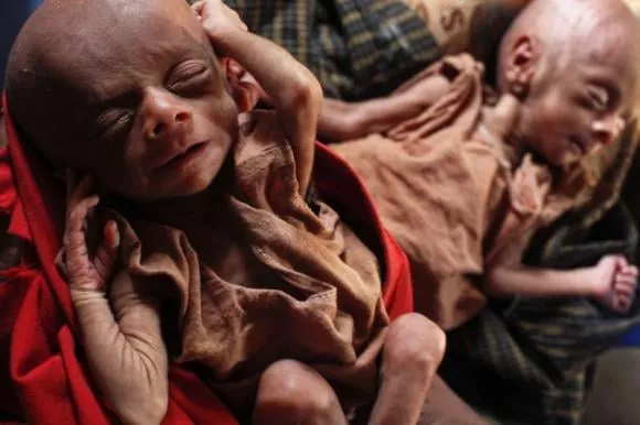 severely malnourished 25 day old twins are held by her mother norbagoun a displaced rohingya woman in their house at the dar paing camp for internally displaced people in sittwe rakhine state april 24 2014 photo reuters severely malnourished 25 day old twins are held by her mother norbagoun a displaced rohingya woman in their house at the dar paing camp for internally displaced people in sittwe rakhine state april 24 2014 photo reuters