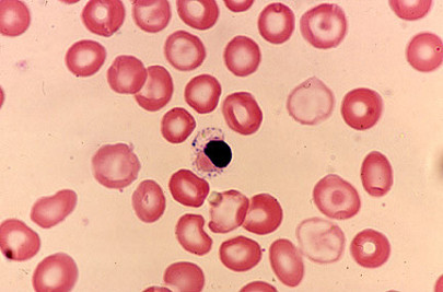 a healthy nation free thalassaemia testing for 100 000 adults