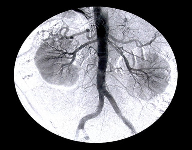 transplant crime three in custody for stealing woman s kidney