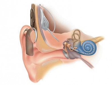 back in action 10 children to get cochlear implants in three days