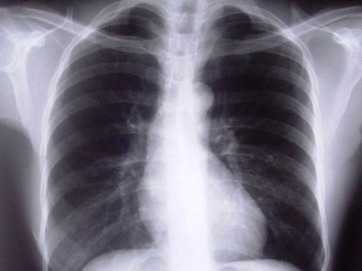 assembly bills tb now a notifiable disease