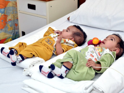 operation successful conjoined twins separated through surgery at akuh operation successful conjoined twins separated through surgery at akuh