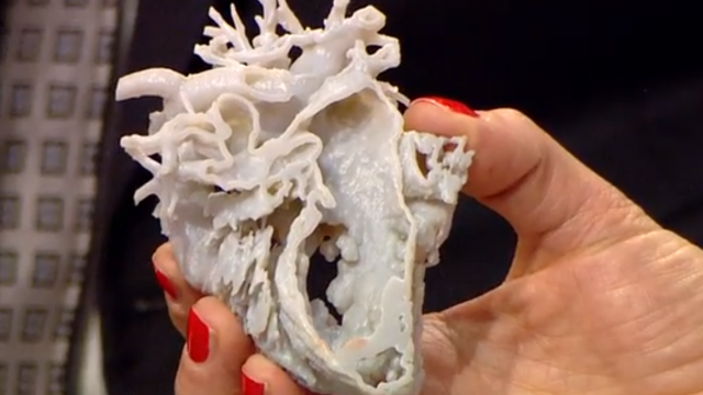 a bbc presenter holds up the 3d printed replica of mina 039 s heart with the hole in the middle the defect for which she had undergo surgery photo bbc screengrab a bbc presenter holds up the 3d printed replica of mina 039 s heart with the hole in the middle the defect for which she had undergo surgery photo bbc screengrab
