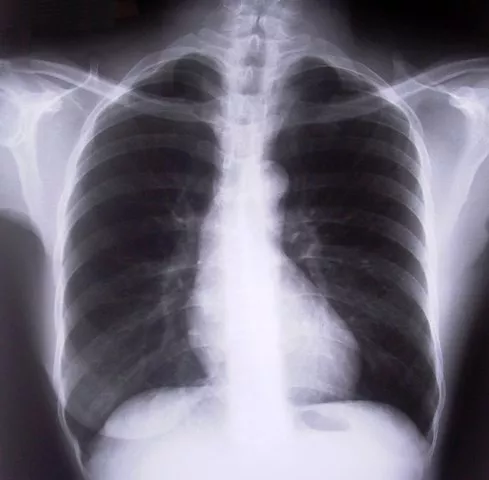 he said lack of data on copd related deaths was alarming photo file he said lack of data on copd related deaths was alarming photo file
