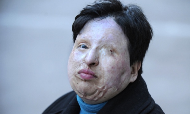 in 2011 ameneh bahrami an iranian woman who was blinded in an acid attack pardoned her assailant photo afp