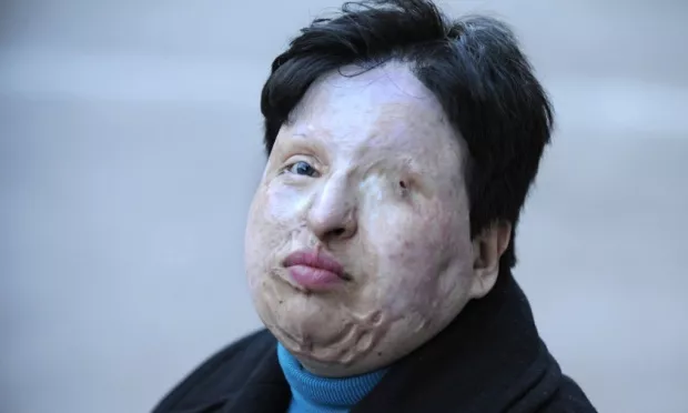 in 2011 ameneh bahrami an iranian woman who was blinded in an acid attack pardoned her assailant photo afp in 2011 ameneh bahrami an iranian woman who was blinded in an acid attack pardoned her assailant photo afp