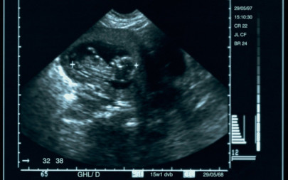 down syndrome can be managed