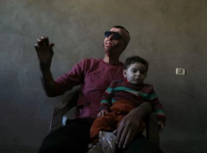 gaza burn victims get 3d printer face masks made close to home