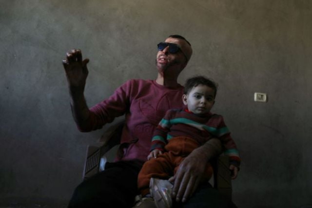 gaza burn victims get 3d printer face masks made close to home gaza burn victims get 3d printer face masks made close to home