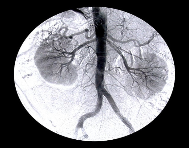 number of people suffering kidney diseases had increased rapidly in the recent years photo file