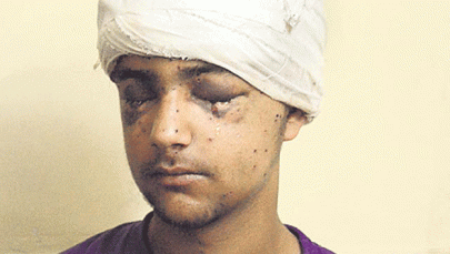 16 year old indian kashmiri boy may lose vision after pellet attack