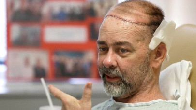 us doctors perform groundbreaking skull scalp transplant