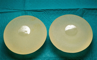 woman carrying cocaine in breast implants arrested at colombia airport