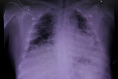 ai detects covid 19 on chest x rays with accuracy speed ai detects covid 19 on chest x rays with accuracy speed