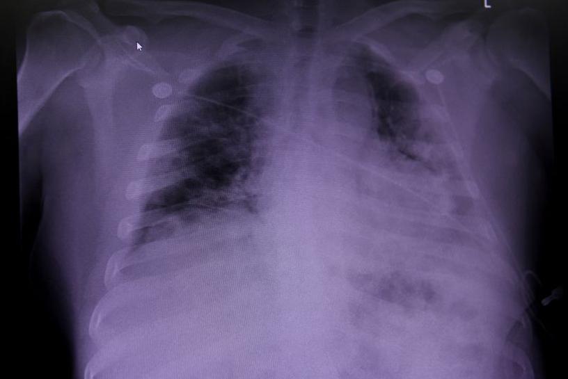 ai detects covid 19 on chest x rays with accuracy speed