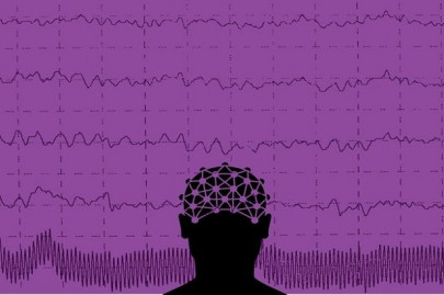 world brain day spread some hope as epilepsy is curable in 70 of the cases world brain day spread some hope as epilepsy is curable in 70 of the cases