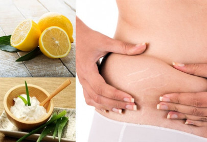 5 tips to get rid of stretch marks 5 tips to get rid of stretch marks
