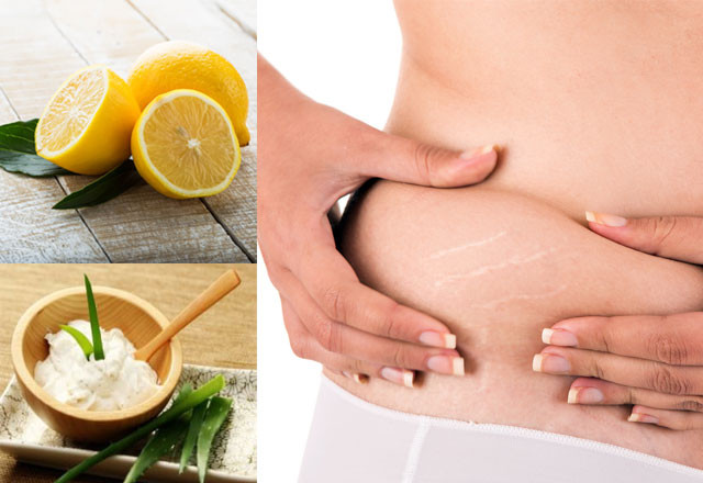 the best a way to erase stretch marks is by eating a nutritious diet and applying lemon juice on affected areas photo file the best a way to erase stretch marks is by eating a nutritious diet and applying lemon juice on affected areas photo file
