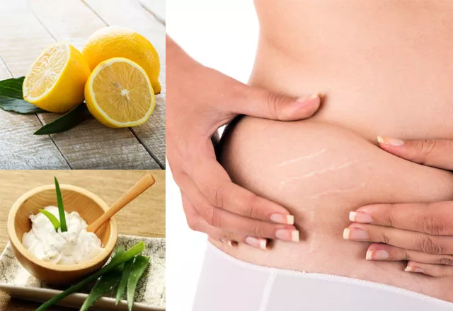 the best a way to erase stretch marks is by eating a nutritious diet and applying lemon juice on affected areas photo file the best a way to erase stretch marks is by eating a nutritious diet and applying lemon juice on affected areas photo file