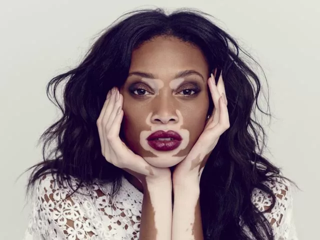 winnie harlow rose to fame after she participated in america 039 s next top model photo fashiongonerogue winnie harlow rose to fame after she participated in america 039 s next top model photo fashiongonerogue