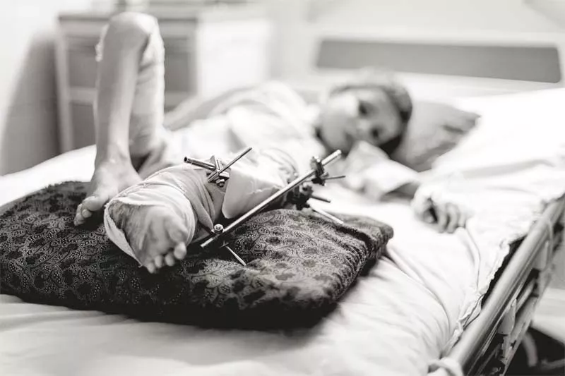 a child rests in his hospital bed as his burnt skin recuperates beneath the bandages photo arif soomro a child rests in his hospital bed as his burnt skin recuperates beneath the bandages photo arif soomro