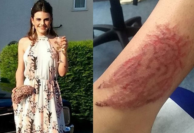 the chemical reaction by black henna has left the skin on her leg permanently damaged by the temporary tattoo the chemical reaction by black henna has left the skin on her leg permanently damaged by the temporary tattoo