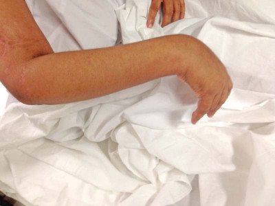 for radial nerve injury patients dr rahman performs miracles