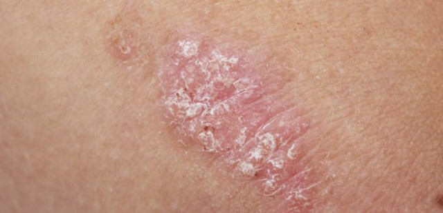 psoriasis rout researchers and health care professionals for decades because it is an extremely difficult disease to treat photo afp psoriasis rout researchers and health care professionals for decades because it is an extremely difficult disease to treat photo afp