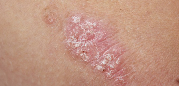 neglected area centres for psoriasis patients needed