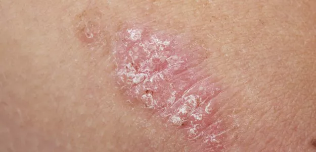 psoriasis rout researchers and health care professionals for decades because it is an extremely difficult disease to treat photo afp psoriasis rout researchers and health care professionals for decades because it is an extremely difficult disease to treat photo afp