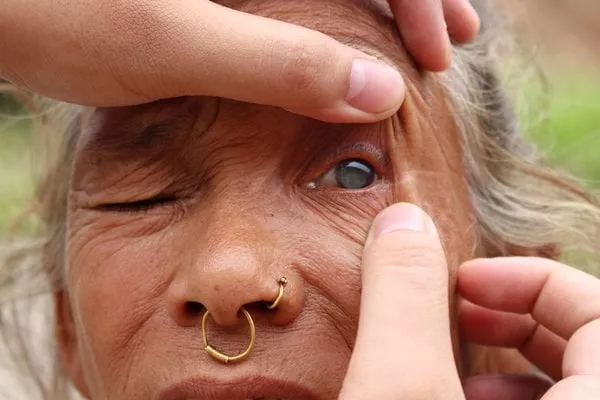 thuli maya thing was blind from cataracts when dr sanduk ruit examined her after surgery she had 20 20 vision photo nicholas kristof the new york times thuli maya thing was blind from cataracts when dr sanduk ruit examined her after surgery she had 20 20 vision photo nicholas kristof the new york times