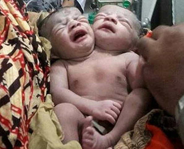 the newborn has two fully developed heads she is eating with two mouths and breathing with two noses the father said photo afp the newborn has two fully developed heads she is eating with two mouths and breathing with two noses the father said photo afp