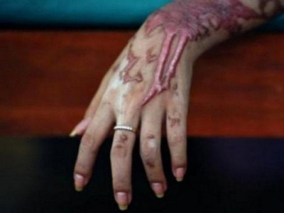 russian tourist scalded in india acid attack police russian tourist scalded in india acid attack police