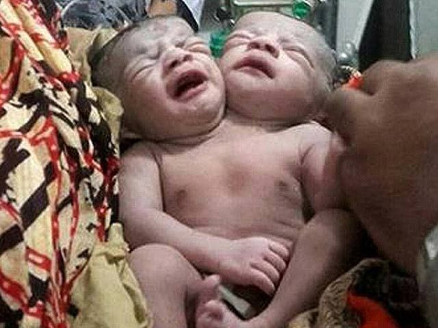 thousands of people had flocked to visit the twins who were born with two heads and two hearts but just one body photo afp thousands of people had flocked to visit the twins who were born with two heads and two hearts but just one body photo afp