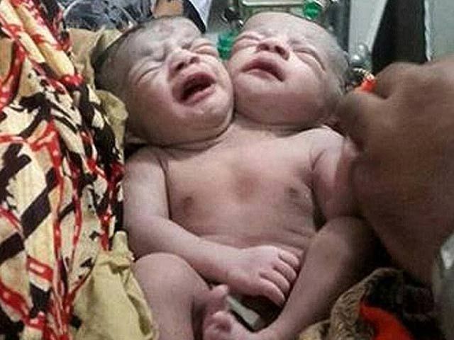 thousands of people had flocked to visit the twins who were born with two heads and two hearts but just one body photo afp