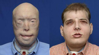 us firefighter gets world s most extensive face transplant us firefighter gets world s most extensive face transplant