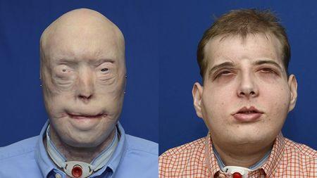 facial transplant patient patrick hardison photo ap