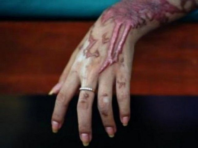 woman loses eye in acid attack by family woman loses eye in acid attack by family