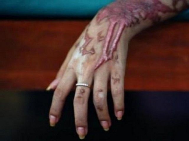 woman doused with acid by husband s first wife