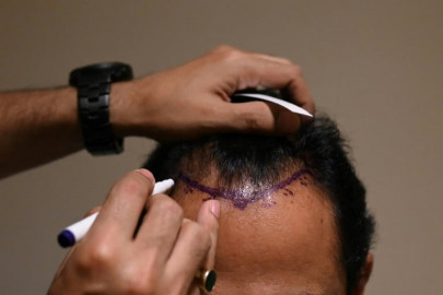 hair transplant fad turns deadly in india hair transplant fad turns deadly in india