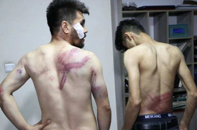 journalists show their injuries after being beaten by the taliban in kabul afghanistan september 8 2021 in this picture obtained from social media photo reuters journalists show their injuries after being beaten by the taliban in kabul afghanistan september 8 2021 in this picture obtained from social media photo reuters
