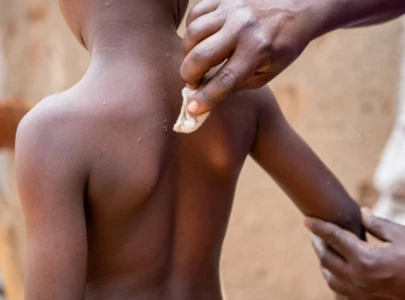 unicef issues emergency call for mpox vaccines