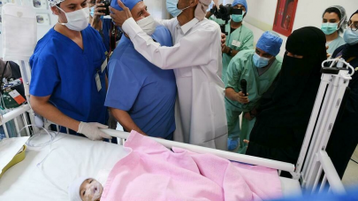 doctors in saudi arabia separate yemeni baby from twin