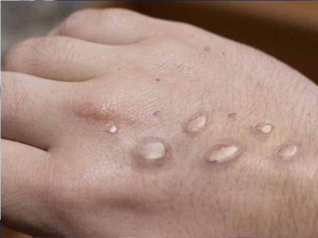 first mpox case of 2025 reported at peshawar airport